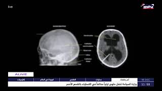 Sante – الاستسقاء الدماغي - د. جان الحاج
