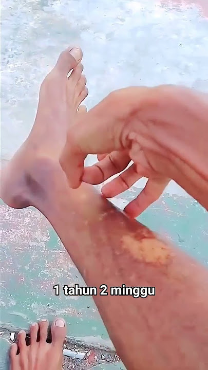 kondisi kaki 1 tahun 2 minggu PO patah tulang tibia & fibula