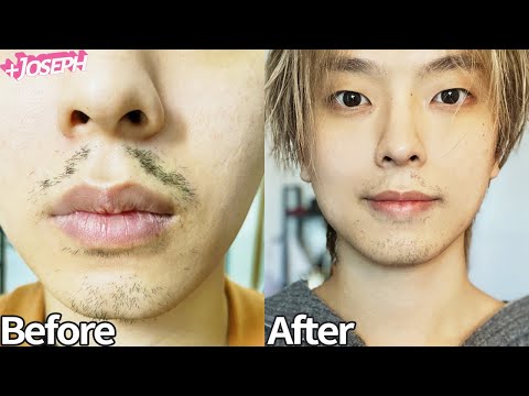 [레이저 제모 후 근황] 이렇게 했더니 병원가서 15번 받아도 안 되던 거 반년 만에 해결했습니다 Self <strong>Laser</strong> Hair Removal Face At Home
