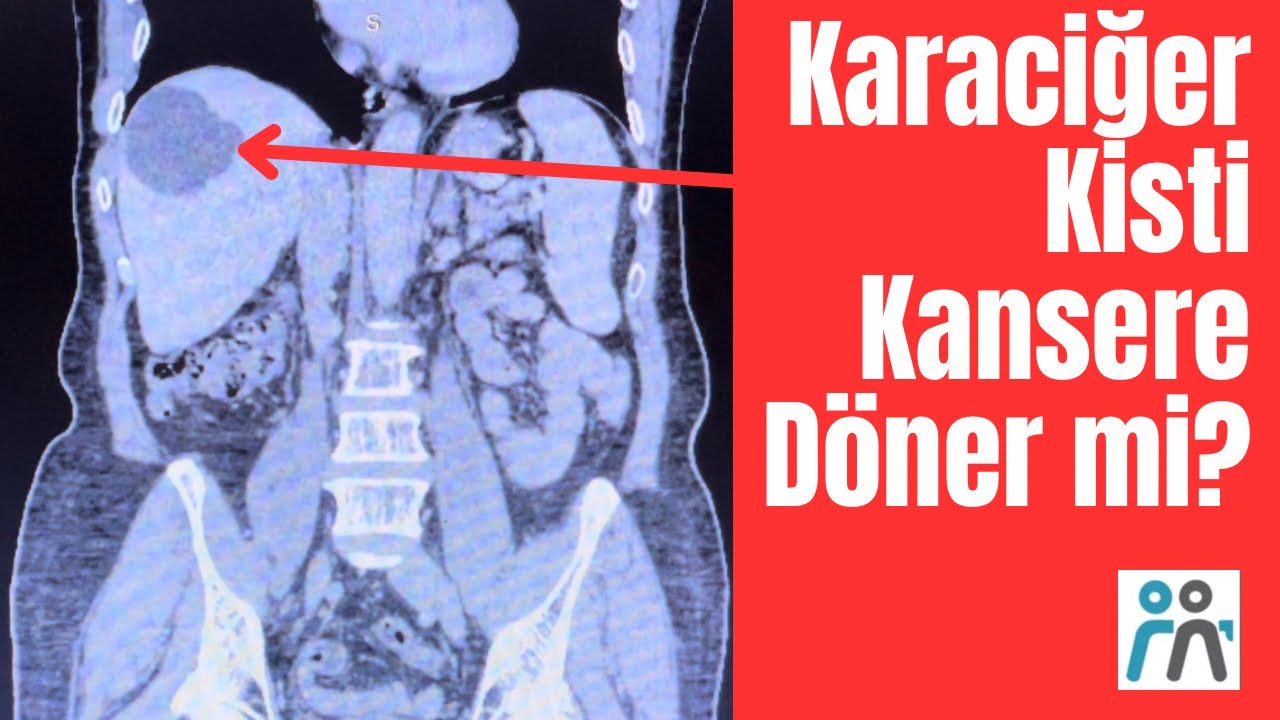 Karaciğer kisti nadiren kanserle birlikte olur