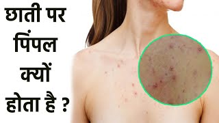 छाती पर पिंपल क्यों होता है | क्या है chest Acne के कारण और उपाय | oldsky