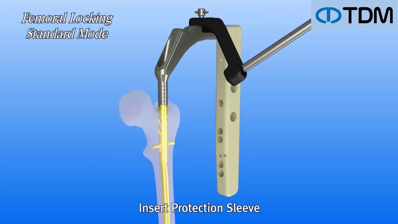 Бедренный Штифт