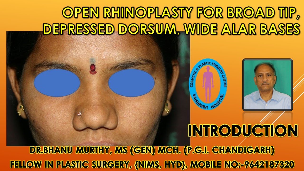 Open rhinoplasty for broad tip, depressed Dorsum, Wide Alar Bases | DR.M. BHANUMURTHY |