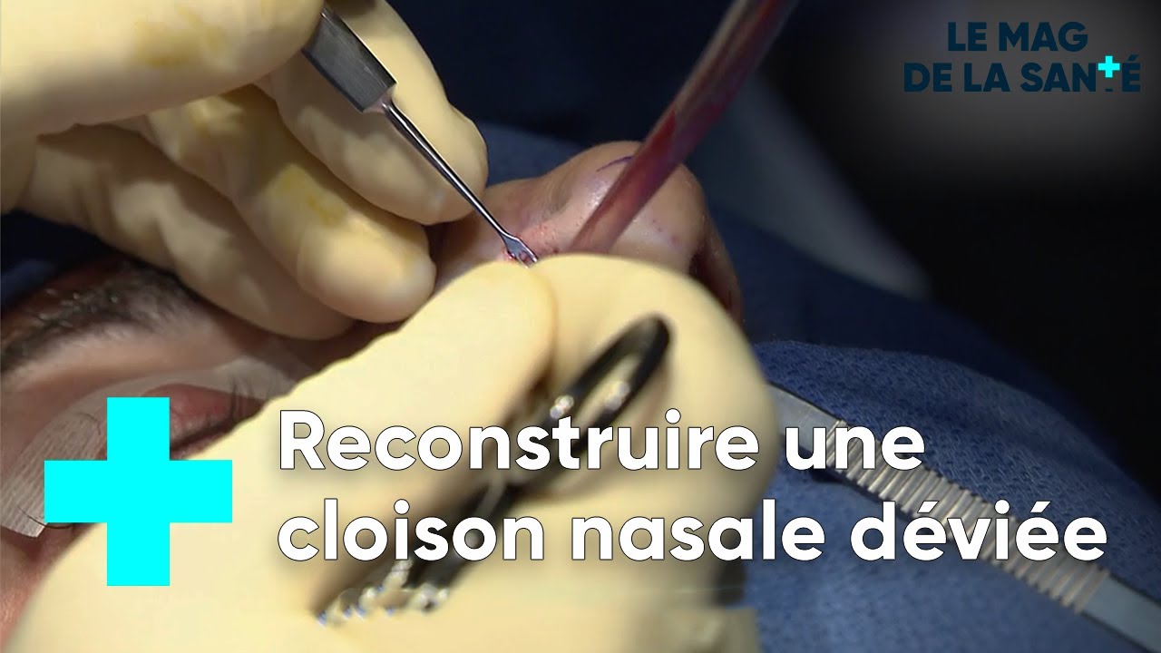 La septoplastie reconstruction d'une cloison nasale déviée Le