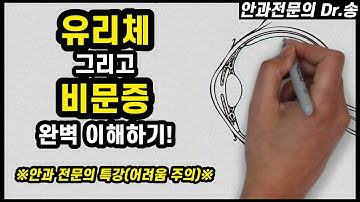 비문증 원인, 그리고 