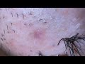 Plucking facial hair & ingrown hair 847 頬髭抜き(埋没毛あり)