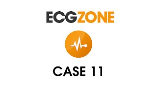 ECG Case 11- Chest Pain with Bradycardia