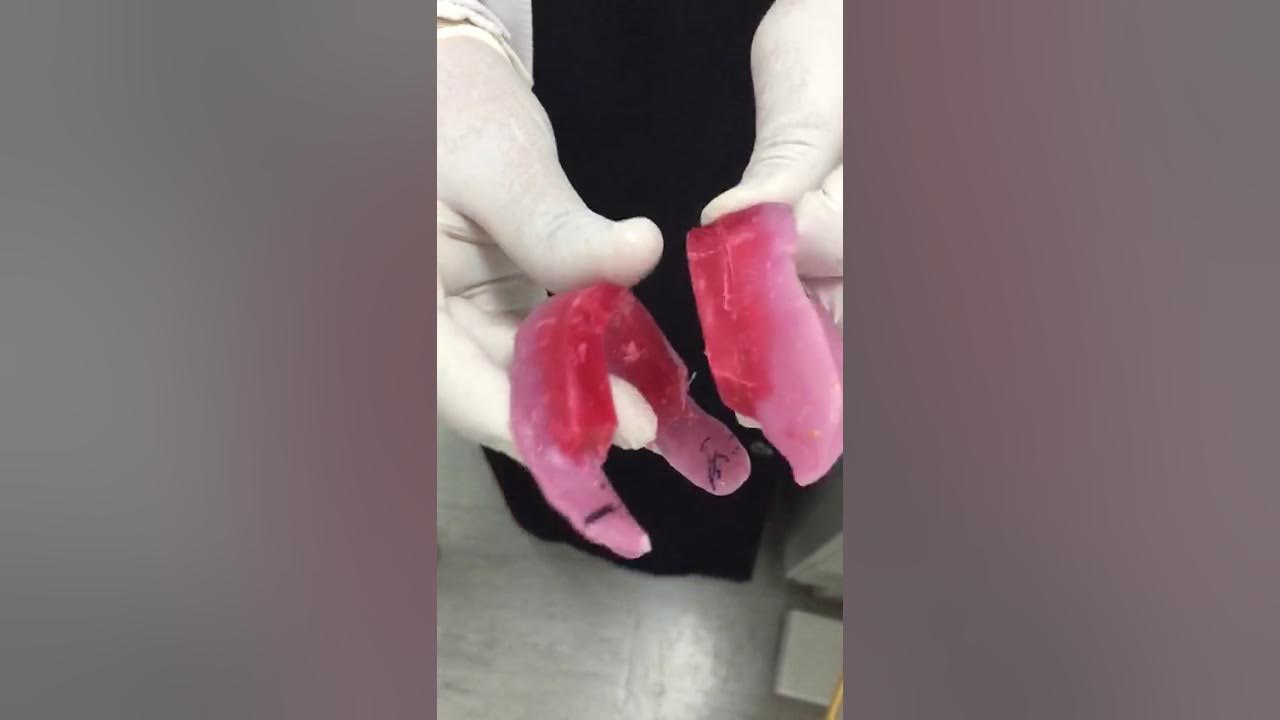 Visit 3 Jaw registration solving the open bite when putting in the