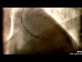Asia Pacific (TW) CTO club Laser for RCA CTO due to ISR of Cypher stents 2016-1-19