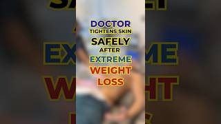 Skin Tightening After Weight Loss 🏥 EXION Technology Explained | #DrMcKenna