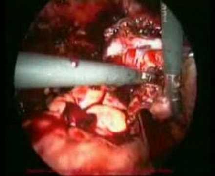 Video: Pembedahan Untuk Endometriosis