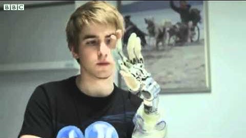 Amputee Patrick demonstrates his world