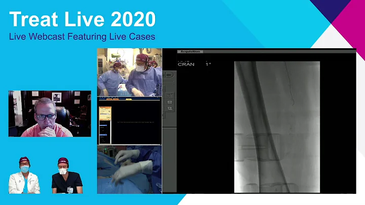 Transradial Endovascular Intervention for CLI (Cri...