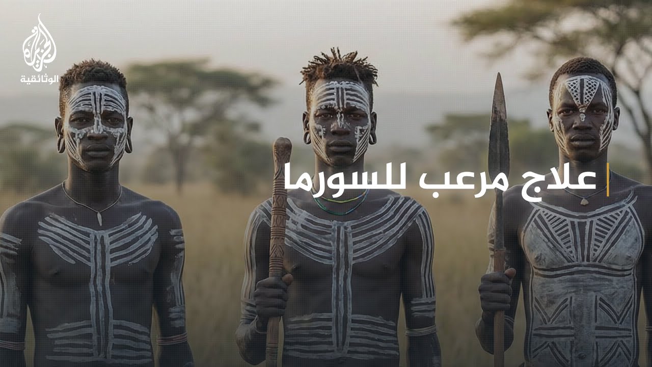 كيف يعالج شعب السورما مرضاهم دون جراحة