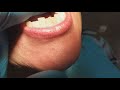 Пациентка &quot;К&quot;. Бюгельные протезы (архивное видео от 21.06.2023).  4 я стоматология.