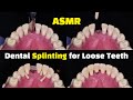 Dental splinting for loose teeth using ribbond after a tooth extraction