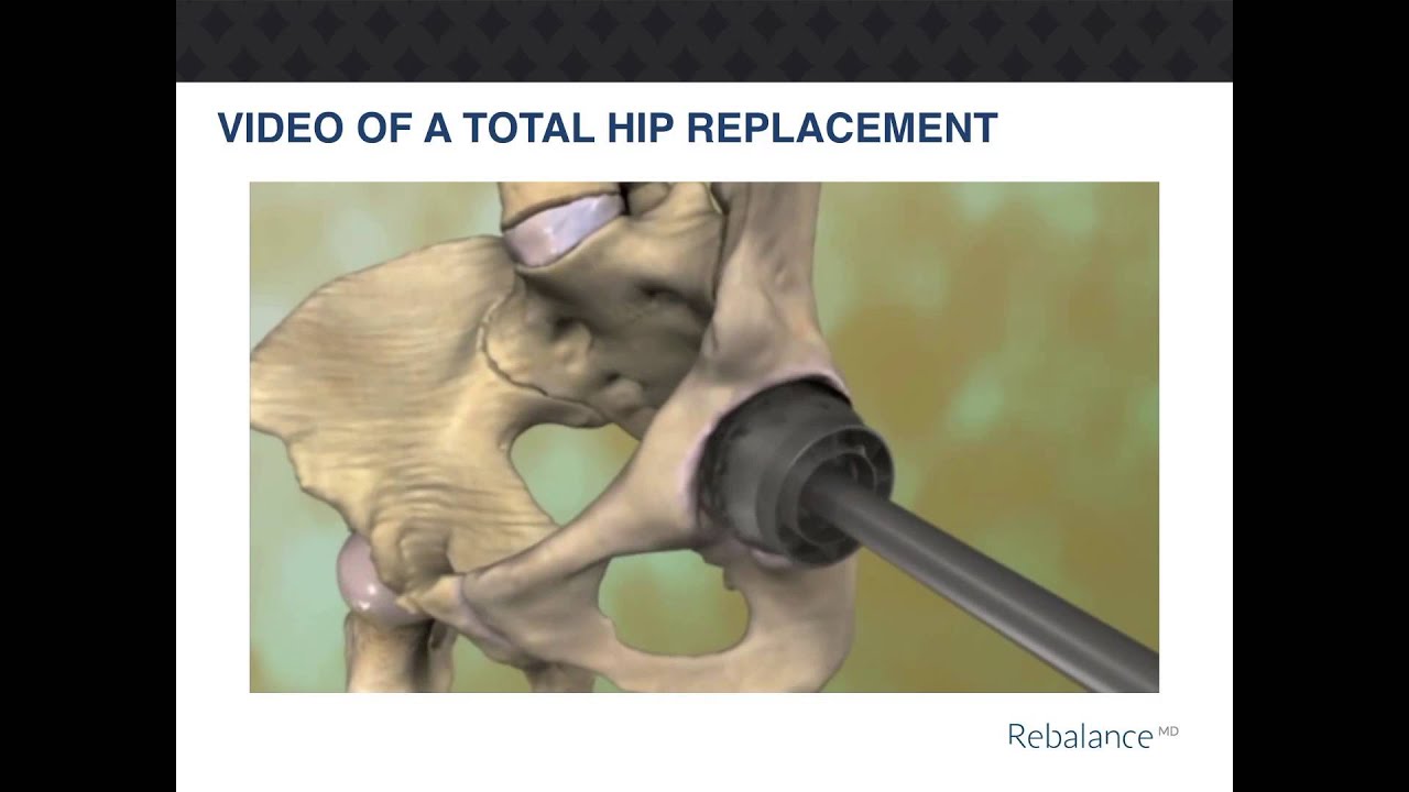 RebalanceMD Total Hip Replacement - YouTube