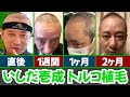 【芸能人】いしだ壱成さんトルコ植毛 2ヶ月後までの経過【植毛大使｜治療｜薄毛の窓口】