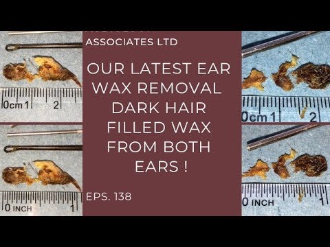 DARK HAIRY EAR WAX REMOVAL - EP 138