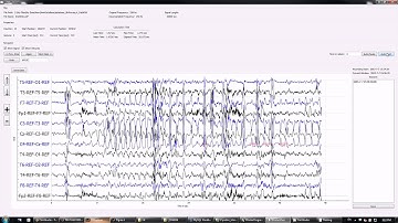 Automated neonatal seizure detector