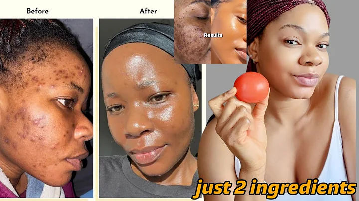 How I used tomato to remove Darkspots,Acne and Hyperpigmentation  #acne #skincare #diy