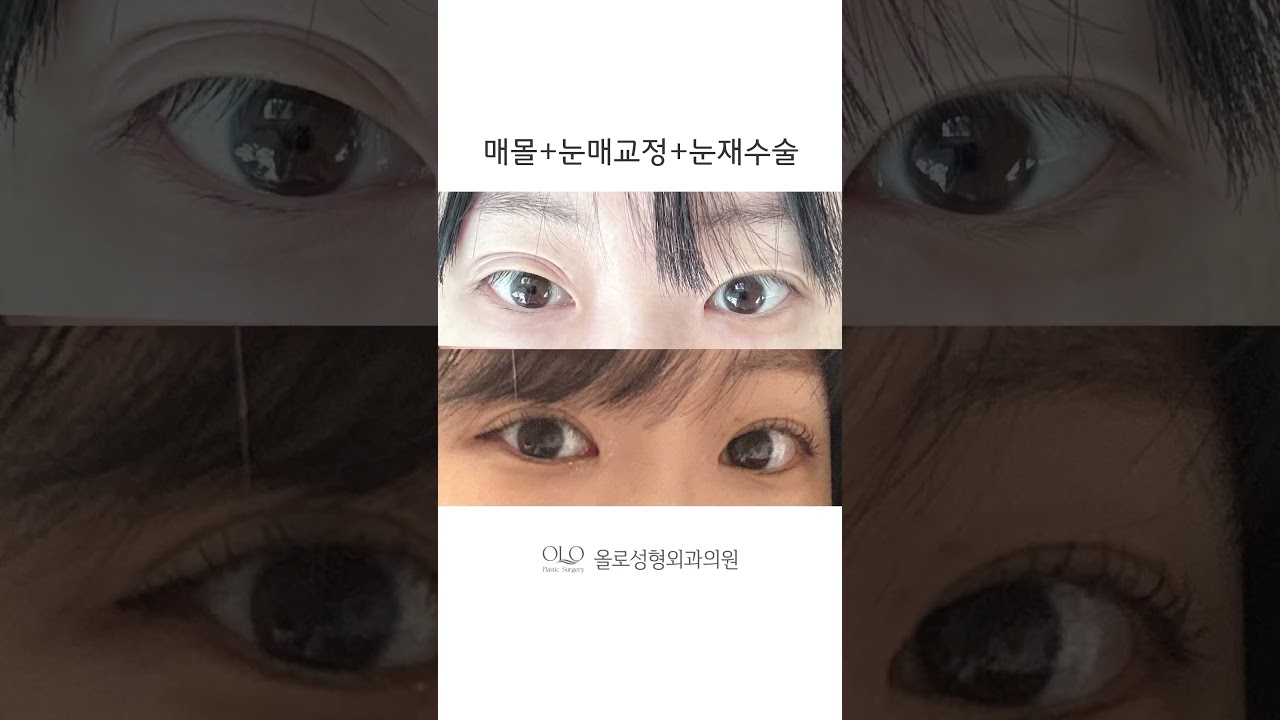 [Оло гоо сайхны мэс заслын эмнэлэг] Сүүлчийн давтан мэс засал Олод! Хувь хүний онцлогт тохирсон нүдний гоо сайхны мэс засал #НүднийГооСайхныМэсЗасал #НүднийГооСайхныМэсЗаслыгСайнХийдэгЭмнэлэг