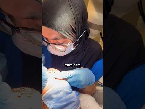 AI Hair Transplant EXPOSED #hairtransplant #haircare #shorts