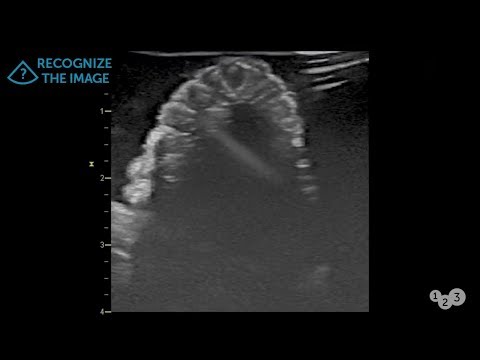 Video: Vai ultraskaņā parādīsies noslēpumaina grūtniecība?