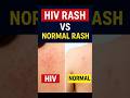 HIV Rash Vs Normal Rash How To Identify The Difference