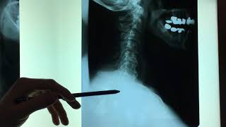 Neck Pain Explained,  X-rays