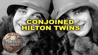 Conjoined Hilton Twins Will Break Your Heart