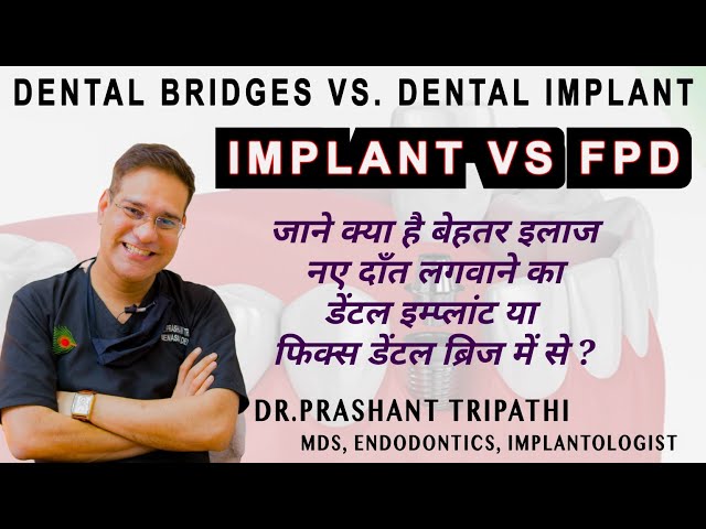 Bridge Or Implant : Which Is Best For You ? FPD vs Implant | Dr Prashant Tripathi | Endodontist class=