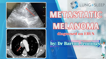 Metastatic melanoma diagnosed on EBUS