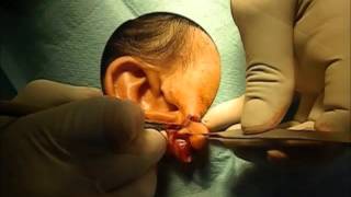 Las orejas vasculitis lóbulos de