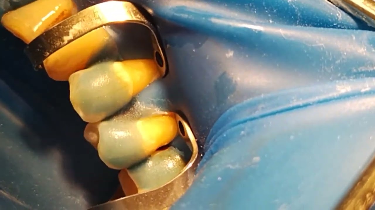 Isolation 42-45 teeth.