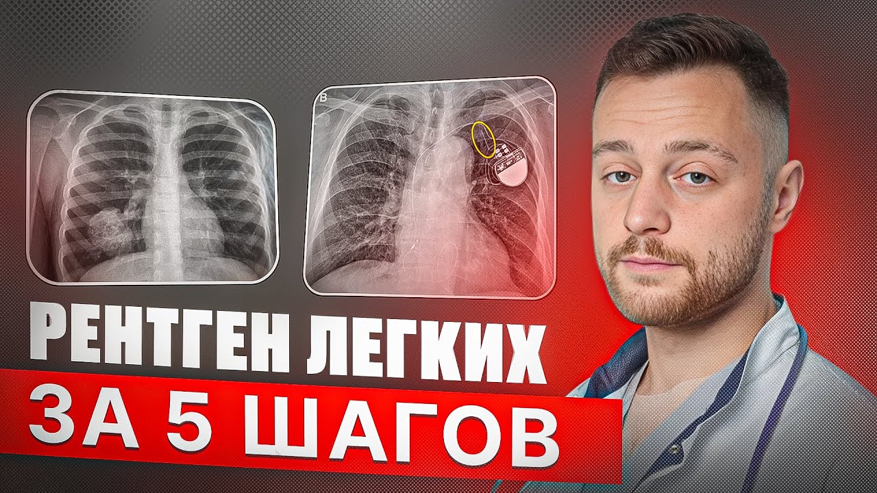 5 простых шагов для чтения рентгена легких