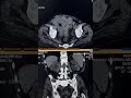 Staghorn calculus in kidney #kidney #calculus #ctscan #medicalimaging #radiology #shorts