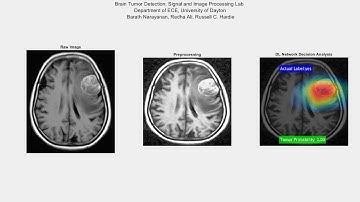 Brain Tumor Detection using Deep Learning