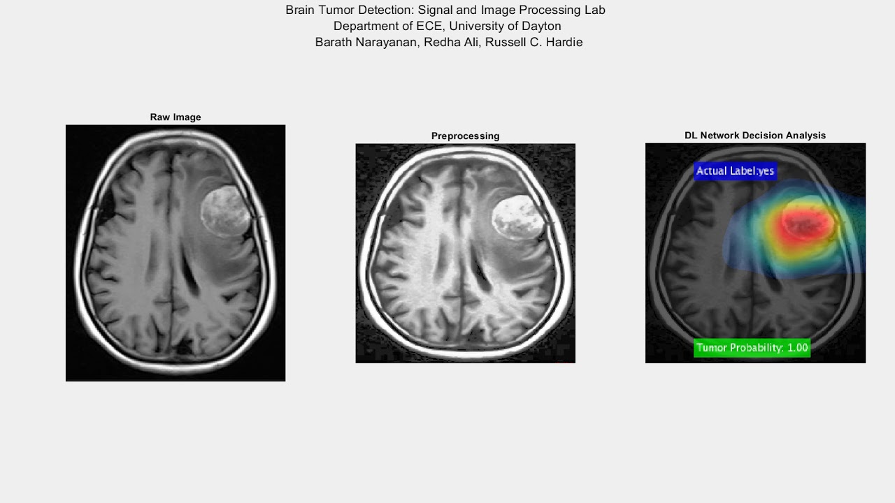 brain tumor detection using deep learning research paper