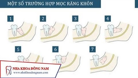 [TÌM HIỂU] Các Dạng Mọc Răng Khôn |NHA KHOA ĐÔNG NAM®