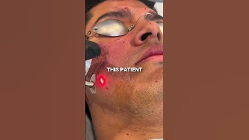 How to treat Icepick + Boxcar Acne Scars #acnescarsremoval #acnescartreatment