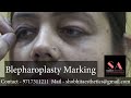 Blepharoplasty marking  dr shobhit gupta