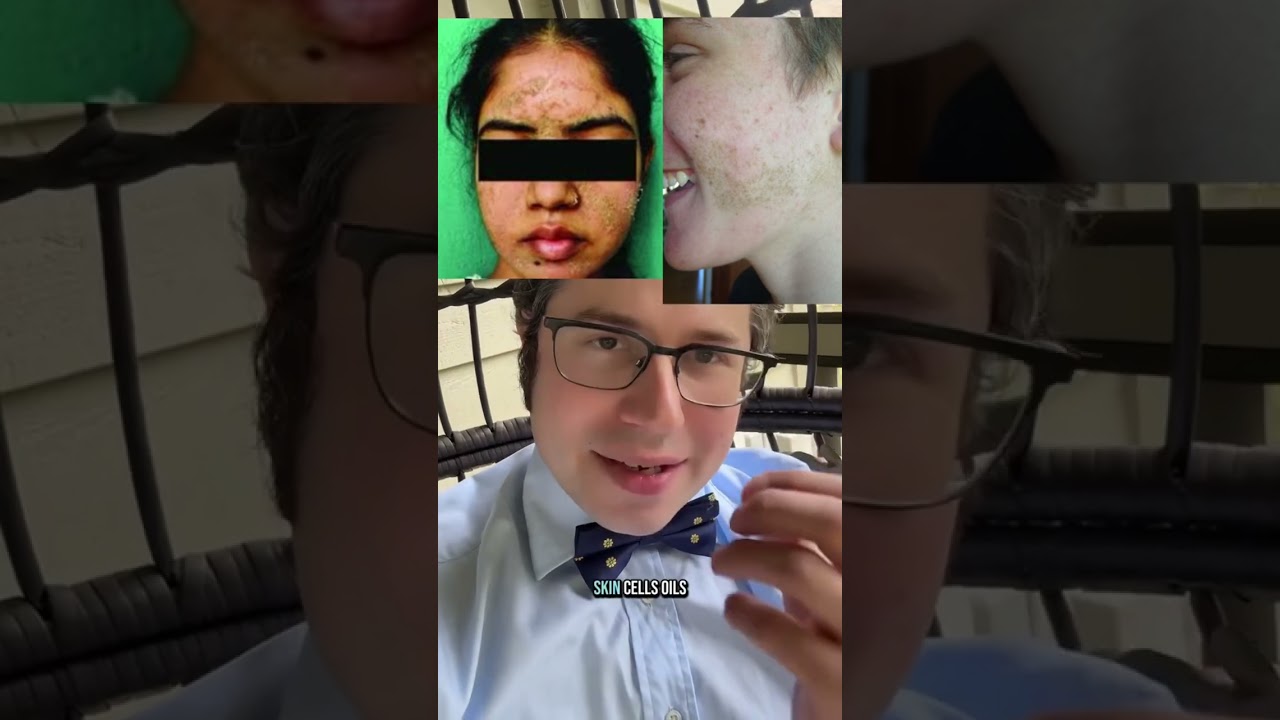 What is the caveman method? What is dermatosis neglecta? 