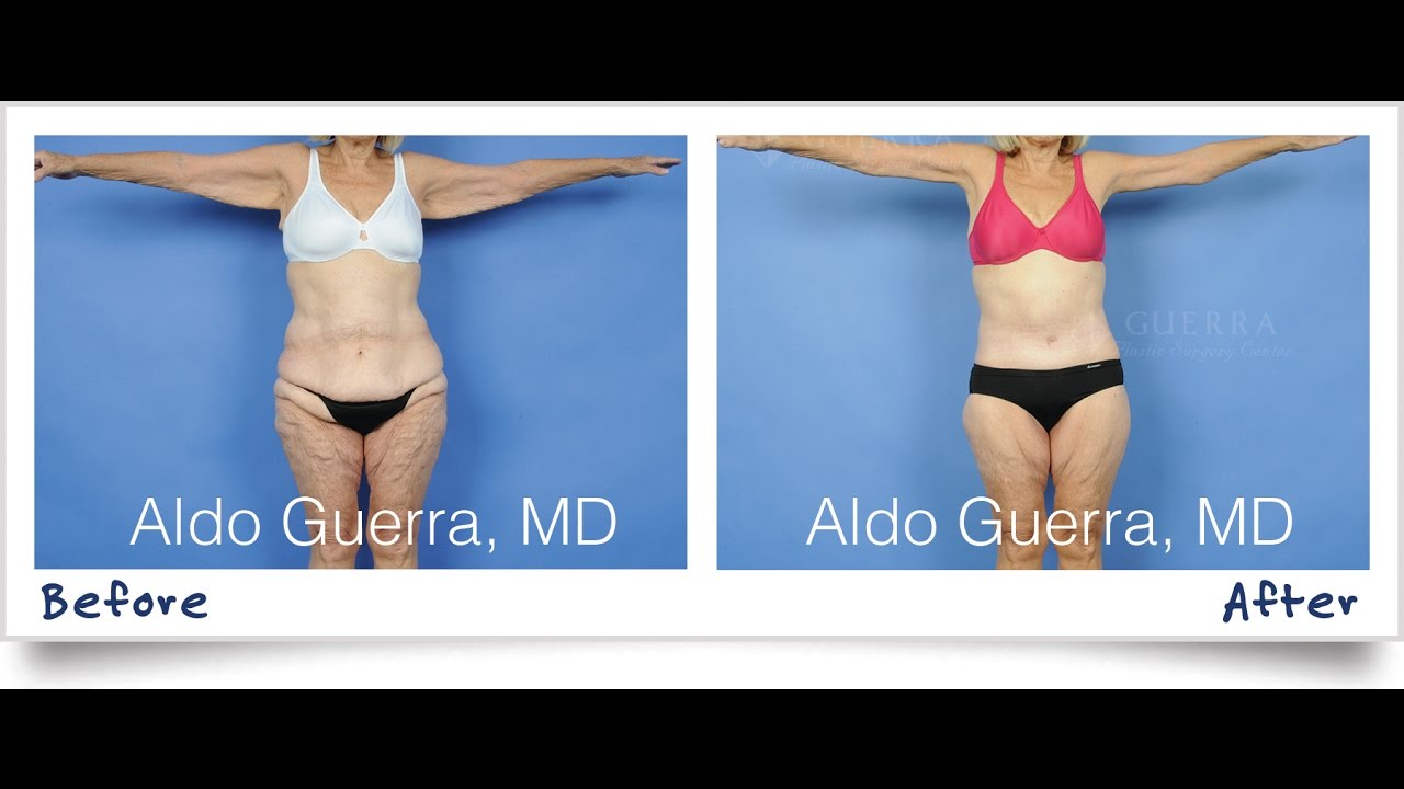 Lower Body Lift Surgery with Dr. Aldo Guerra