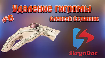 Гигрома.  Удаление гигромы. Алексей Скринник ✌️ ✌️ ✌️