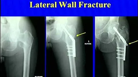Peritrochanteric Fractures- DHS Vs IM Nail