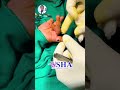 Extra Finger Removed Successfully | Polydactyly Surgery by Dr. Suneel Kishore