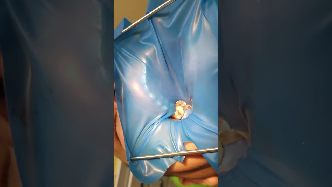 Single isolation 17 tooth.