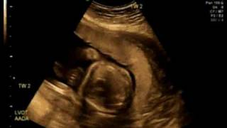 20_Weeks_3b.avi
