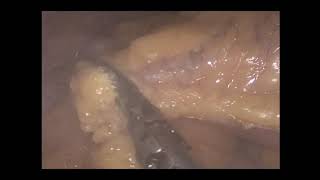 Omentectomía videlaparoscópica en el tratamiento de cáncer de ovario temprano